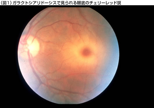（図1）ガラクトシアリドーシスで見られる眼底のチェリーレッド斑
						
