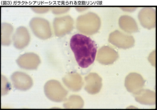 （図3）ガラクトシアリドーシスで見られる空胞リンパ球